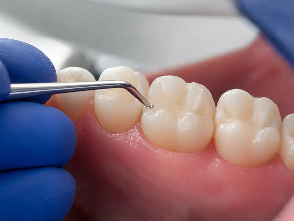 Tooth-colored dental restoration